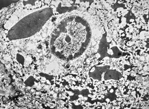 F, 11y. | ichthyosis hystrix type Curth-Macklin F, 11y. | ichthyosis hystrix type Curth-Macklin